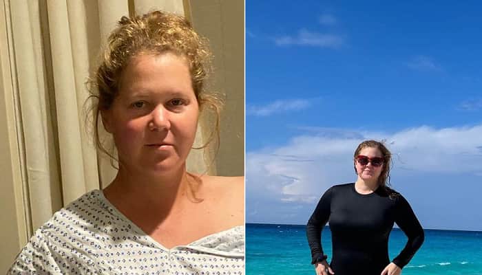 Amy Schumer shows off weight loss after liposuction: ‘I feel good’